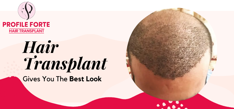 A hair transplant procedure will make you look good and improve your confidence