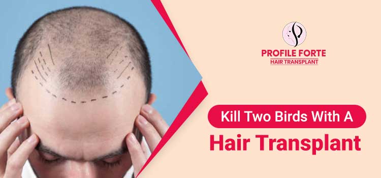 Can You Cure Your Migraine Problem With Hair Transplant Surgery?