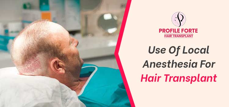 Detailed guide on the use of local anesthesia for hair transplant surgery