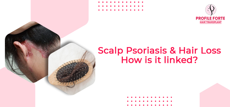 What’s the relation between scalp psoriasis and hair loss problem?