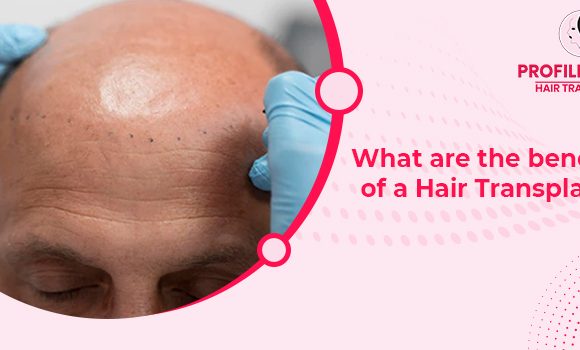 Hair loss solution: 5 top benefits of undergoing hair transplant treatment