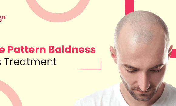 What Is Male Pattern Baldness, Its Common Causes And Treatment?