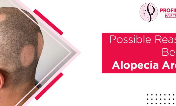 Hair Loss: What are the possible reasons behind alopecia areata?