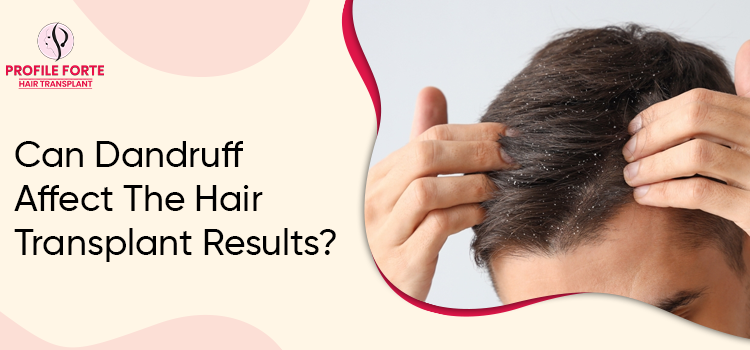 Let’s shed light on the Dandruff effect on hair & hair transplant results