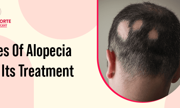 What are the types of alopecia, and how to find the right treatment?