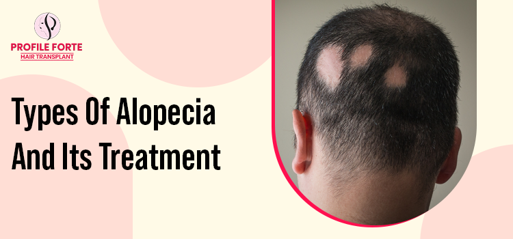 What are the types of alopecia, and how to find the right treatment?
